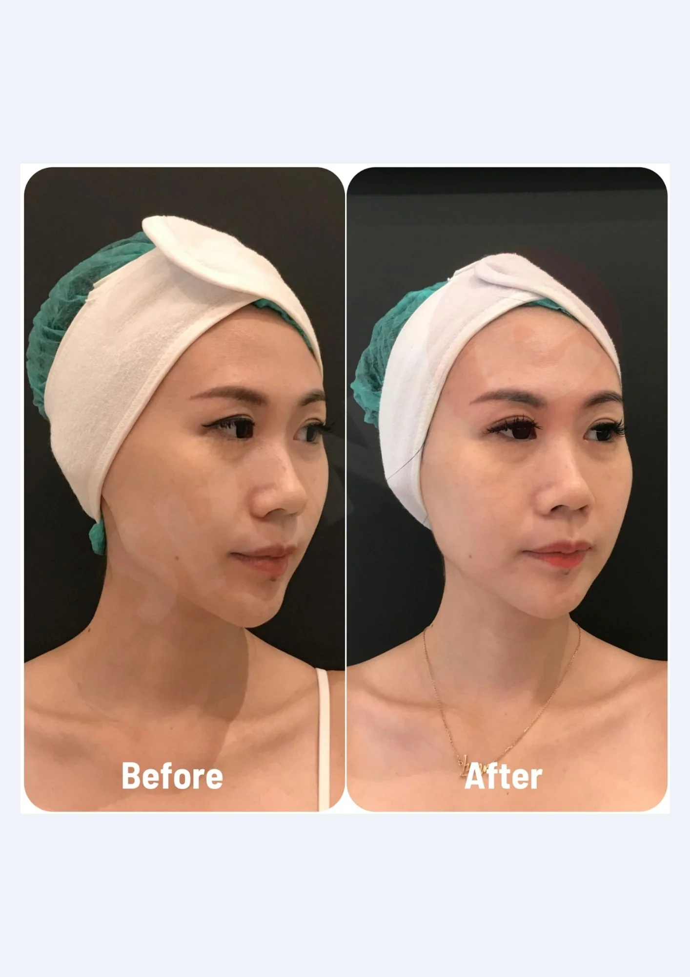 Lip Filler